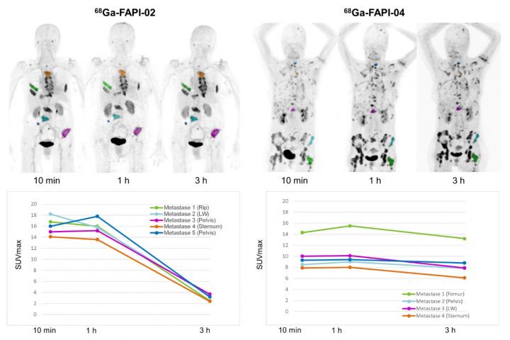 Images Of Nuclear Medicine Tracers At Different Imaging Time Points In Two Patients With Metastasize