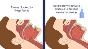 Nasal spray for sleep apnea process