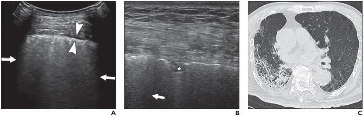 82-Year-Old Man Who Presented with Cough, Dyspnea, and Fever for 10 Days