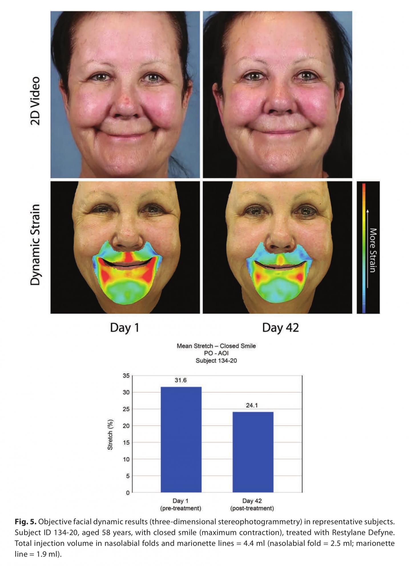 Hyaluronic Acid Fillers