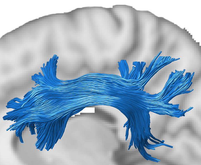 Superior longitudinal fasciculus (SLF), a white matter tract that connects the prefrontal and parietal cortex