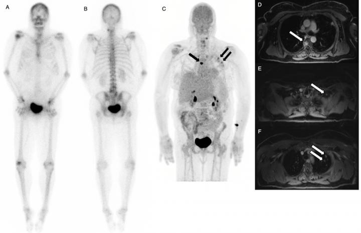 A 50 Year-Old Woman with Recurrent Breast Cancer