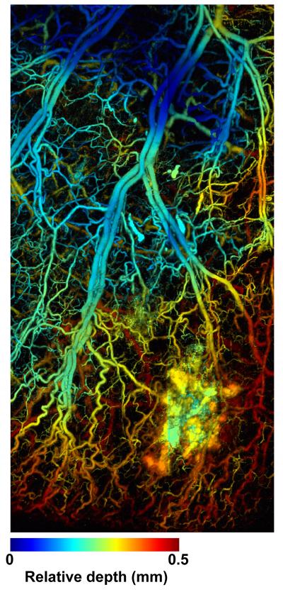 Tumor Image with Photoacoustic Microscopy