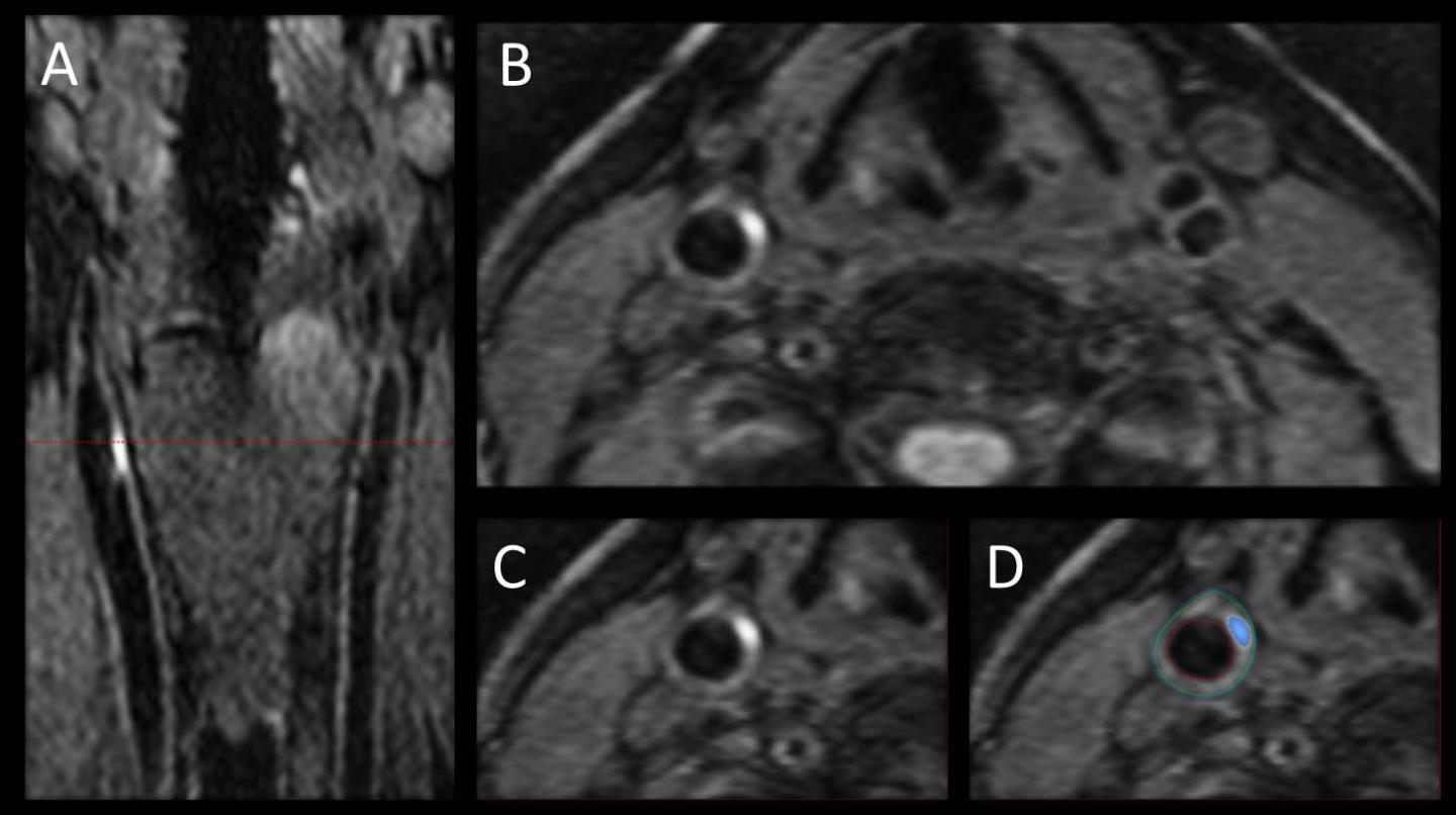 Figure 1: Intraplaque Hemorrhage