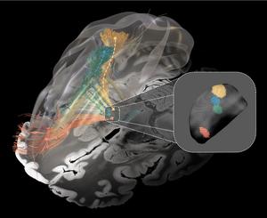 Affected brain circuits in Parkinson’s disease, dystonia, Tourette’s syndrome, and obsessive-compulsive disorder.