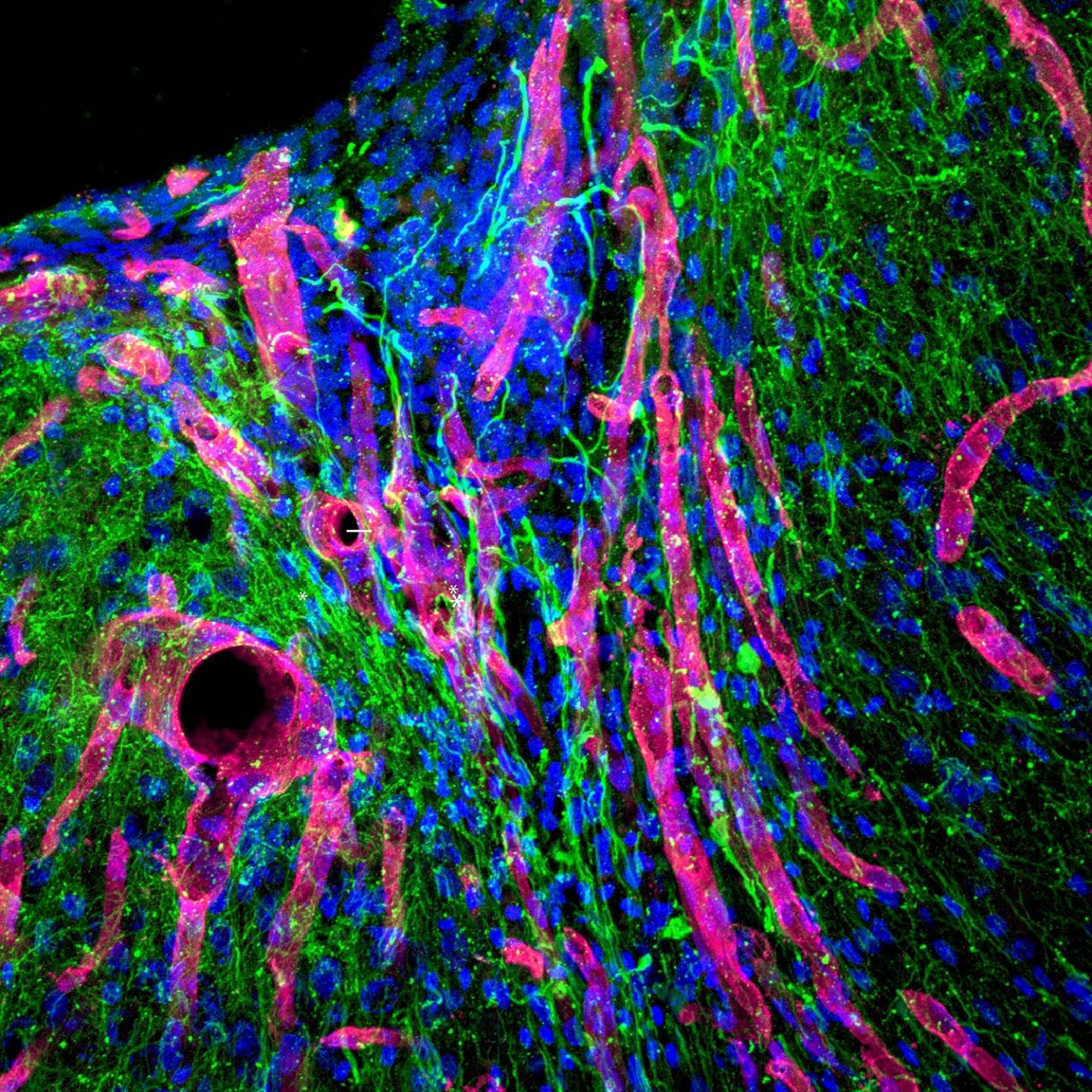 New Brain Tissue Fills Stroke Cavity