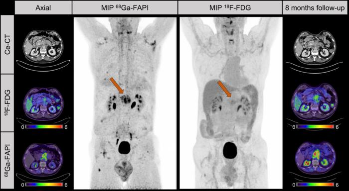 Case presentation. Male patient with suspected recurrent pancreatic cancer.