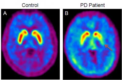 Brain Images of Patients with and without Parkinson's Disease