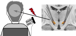 Study shows that activity in the subthalamic nucleus reflects action outcomes and consequent adaptation in humans; this can be modified through bursts of electrical stimulation, with potential to restore healthy brain function in people with neurological