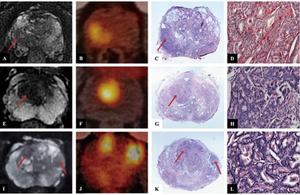 Magnetic resonance imaging (MRI), prostate-specific membrane antigen positron emission tomography/computed tomography (PSMA PET-CT), and hematoxylin & eosin staining imaging of three representative cases