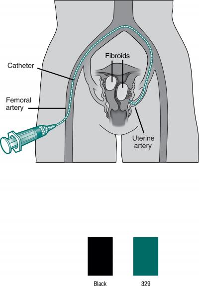 UFE: Catheter View