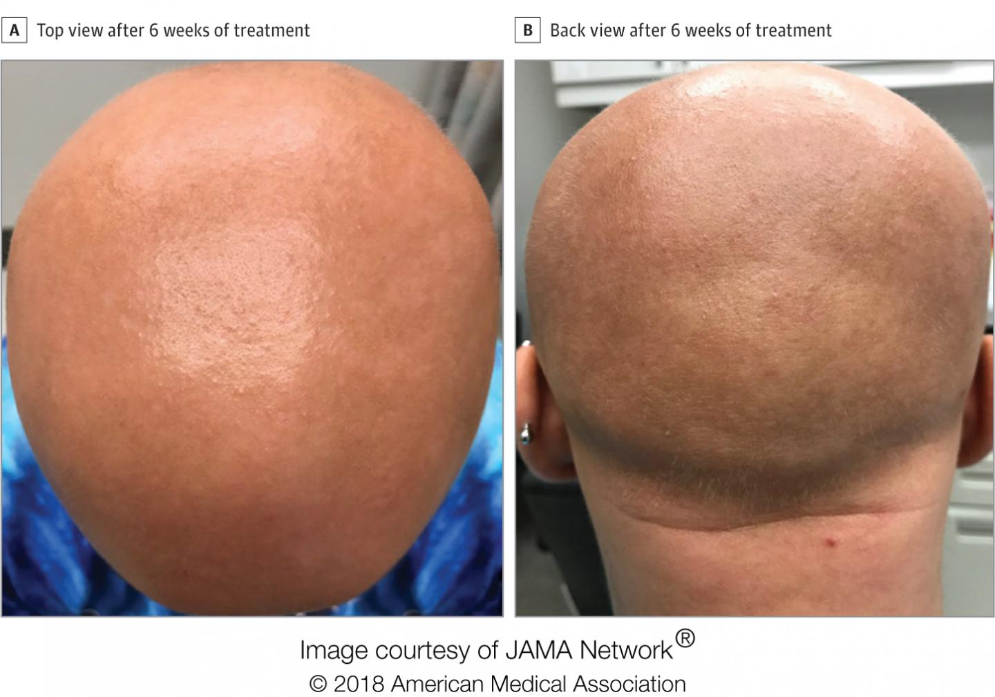 Hair Regrowth in Alopecia Patient Treated with Dupilumab