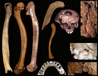 Examples of Developmental Abnormalities in Pleistocene People