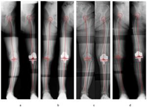 Representative images before and after knee replacement surgery