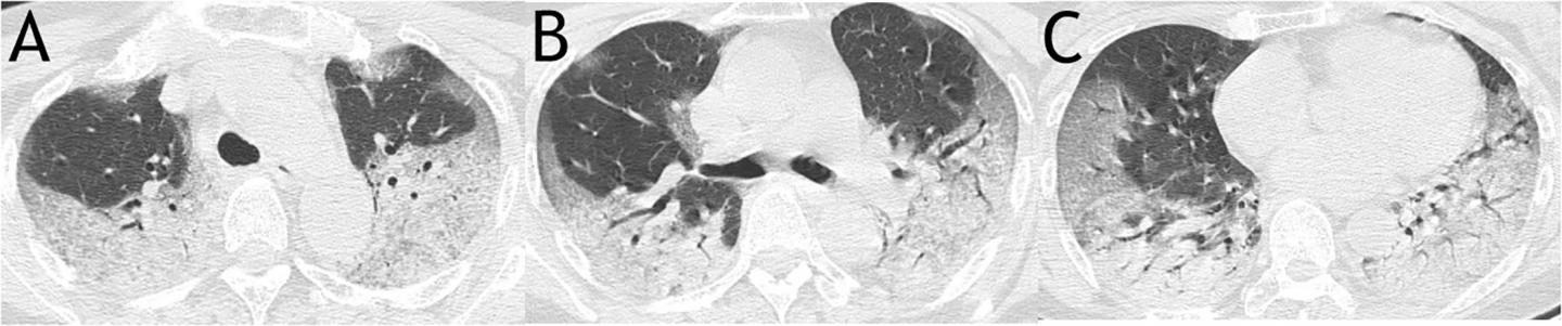 Two COVID-19 Papers Published in PLOS ONE