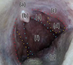 Still image from a video of the oropharynx