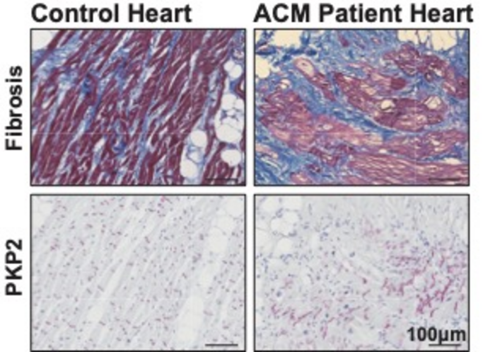 Figure 2: Disorganized plakophilin-2 (PKP2) in severely fibrotic regions of the heart of ACM patients. Top panels show fibrotic tissue (blue), fat tissue (white) and heart muscle cells (red) of control and ACM patient hearts. Bottom panels show the protein localization of plakophilin-2 in the hearts of a healthy individual and an ACM patient.