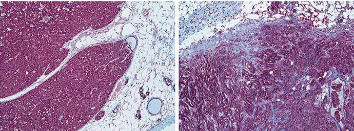A Tale of 2 Tumor Environments