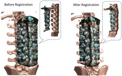 Images of Spine before Registration and After Registration Using iSV