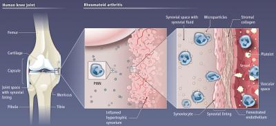 Platelets Stoke the Fire of Rheumatoid Arthritis (2 of 2)