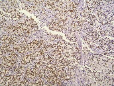 Tumors with Mutated p53