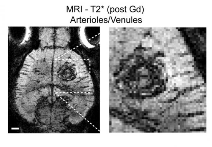 Brain Tumor Vascularisation