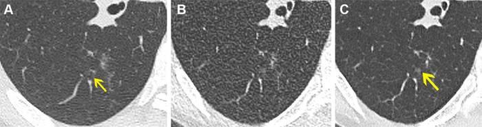 Noncontrast chest CT lung window images in a 61-year-old female participant.