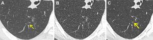 Noncontrast chest CT lung window images in a 61-year-old female participant.