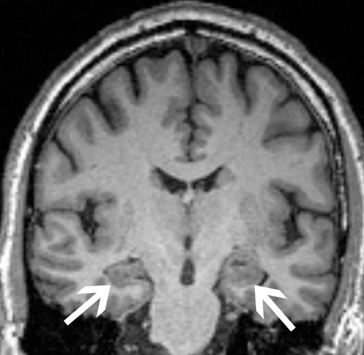 Anxiety Associated with Faster Alzheimer's Disease Onset
