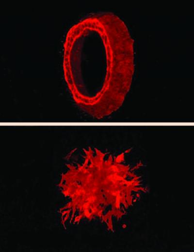 Likely Culprit in Spread of Colon Cancer Identified