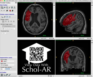 lesion segmentation