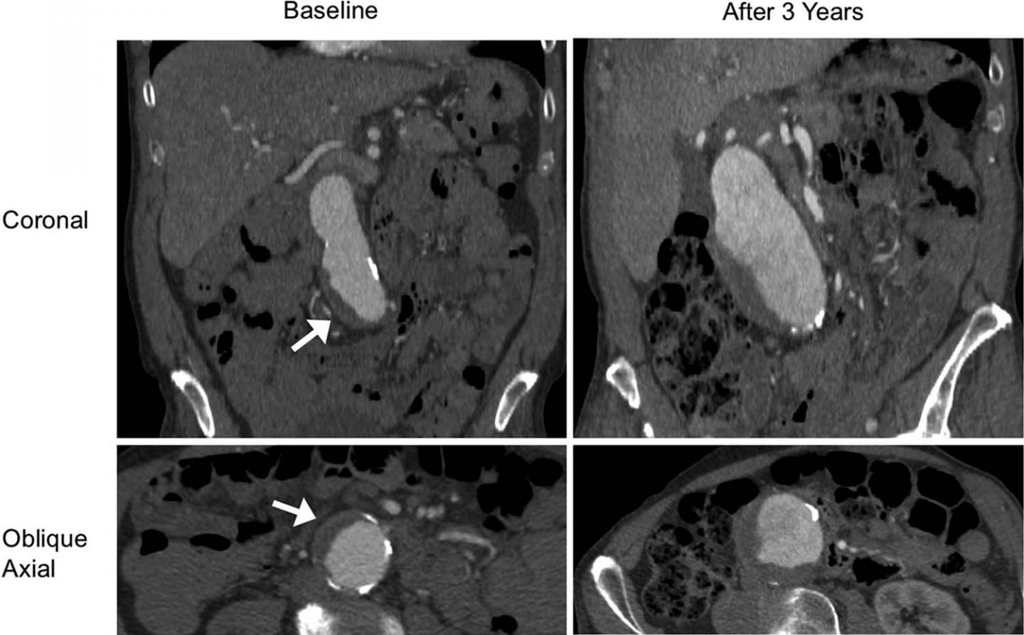 Intrauterine blood clot, Radiology Reference Article