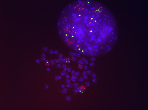 Sotorasib-resistant lung cancer cells displaying multiple copies of the mutated KRAS gene (in red) / CICANCER