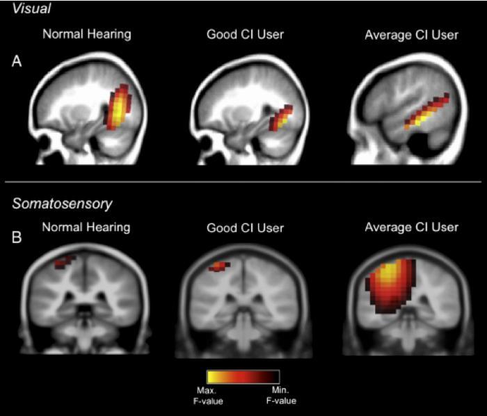 Hearing impairment is associated with cognitive decline, brain