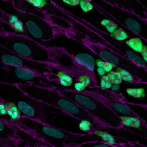 Neutrophils attaching to endothelial cells in cystic fibrosis airway