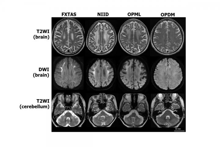 MRI Brain Scans of Patients with Similar Neurodegenerative Symptoms