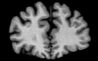 MRI Scan of a 79-year-old Male Human Brain