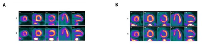 Cardiac positron emission tomography (PET) perfusion images for two sleep apnea patients.