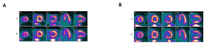 Cardiac positron emission tomography (PET) perfusion images for two sleep apnea patients.