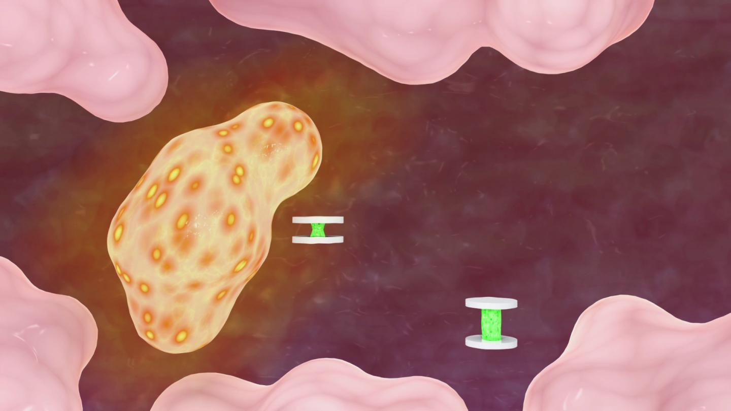 Precocious GEM: Shape-Shifting Sensor Can Report Conditions from Deep in the Body