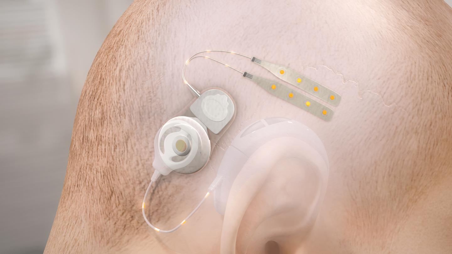 Artist's Impression of the Minimally Invasive Brain Stimulation and Recording System