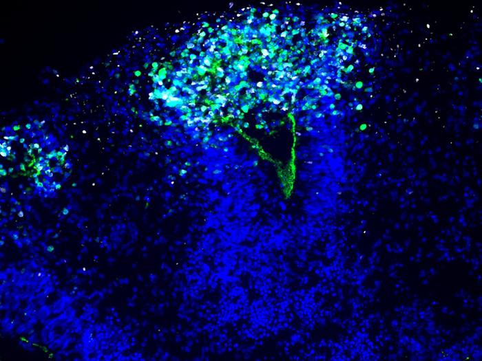 The image shows how the herpes virus (white) spreads into the organoid and destroys the integrity of the neuroepithelium lining the ventricle (nuclei in blue, green marker for the neuroepithelium).