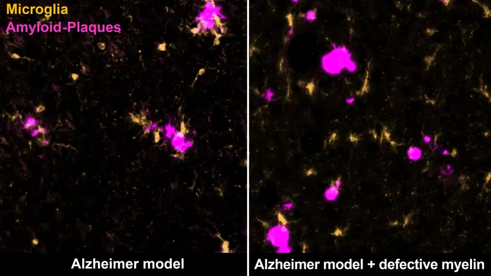 Microglia and amyloid plaques