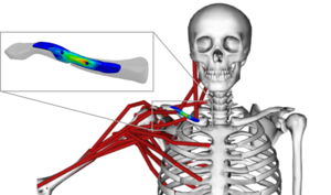 Patient-specific plates may help heal collarbone fractures