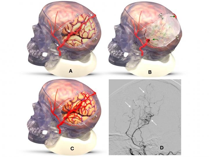 Stroke Study 10-18-18
