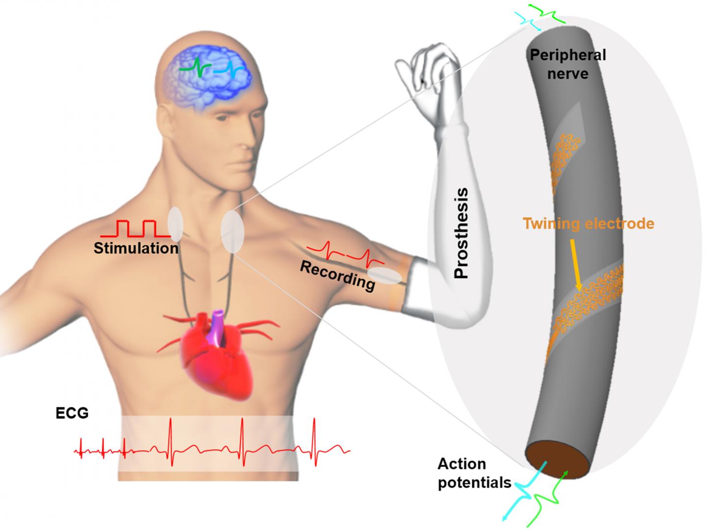 Peripheral Nerve Stimulation