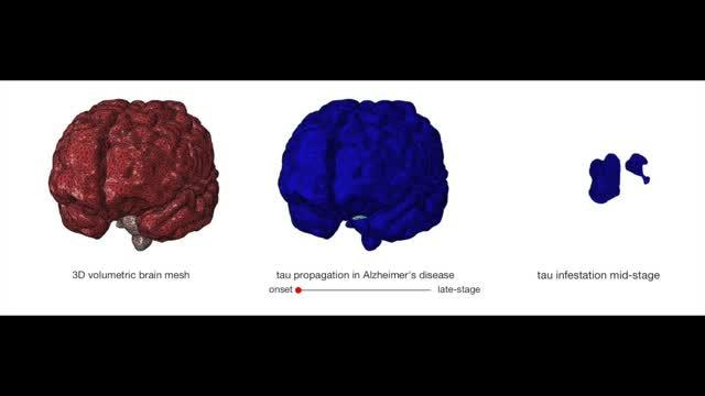 Watch Tau Infiltrate Brain in Alzheimer’s