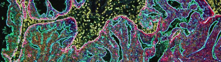 Stylized Image of Prostate Cancer From a Man with a Brca2 Mutation