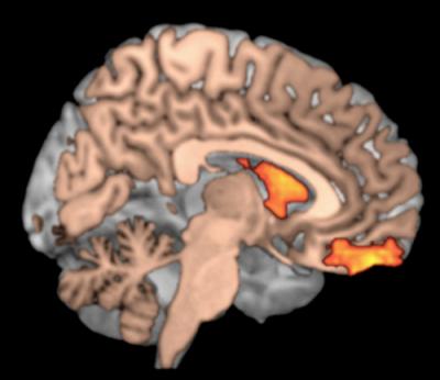 Dopamine Brain Scan