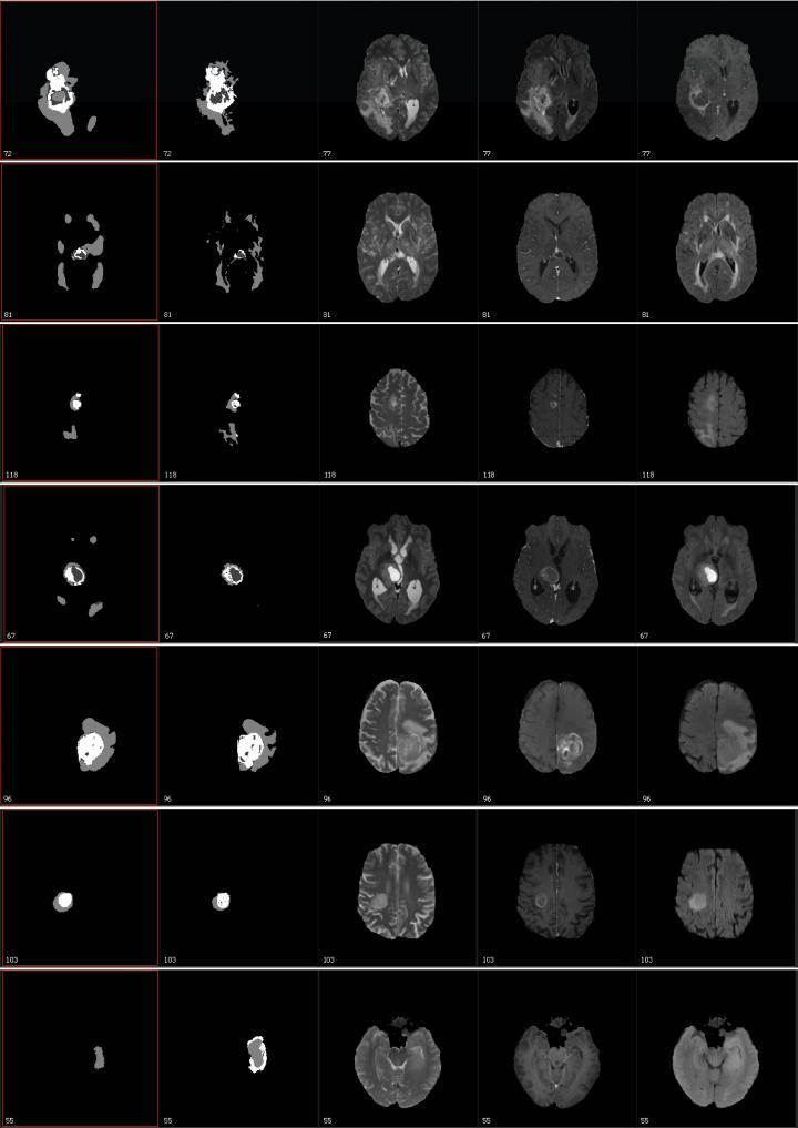 Brain Images from the BRaTS Challenge